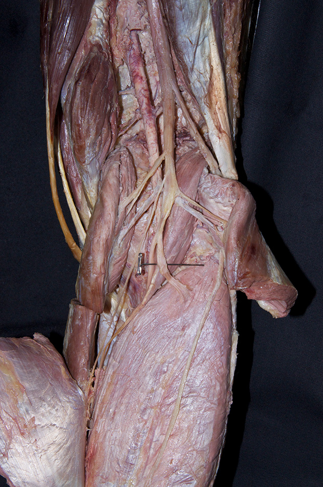 Tibial Nerve (soleal branch)