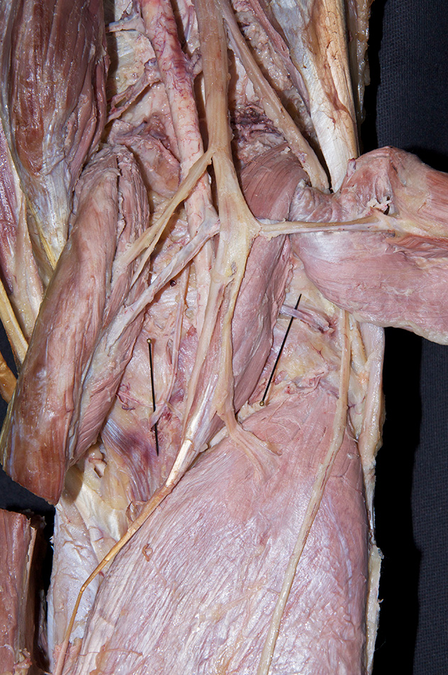 Inferior Genicular Arteries