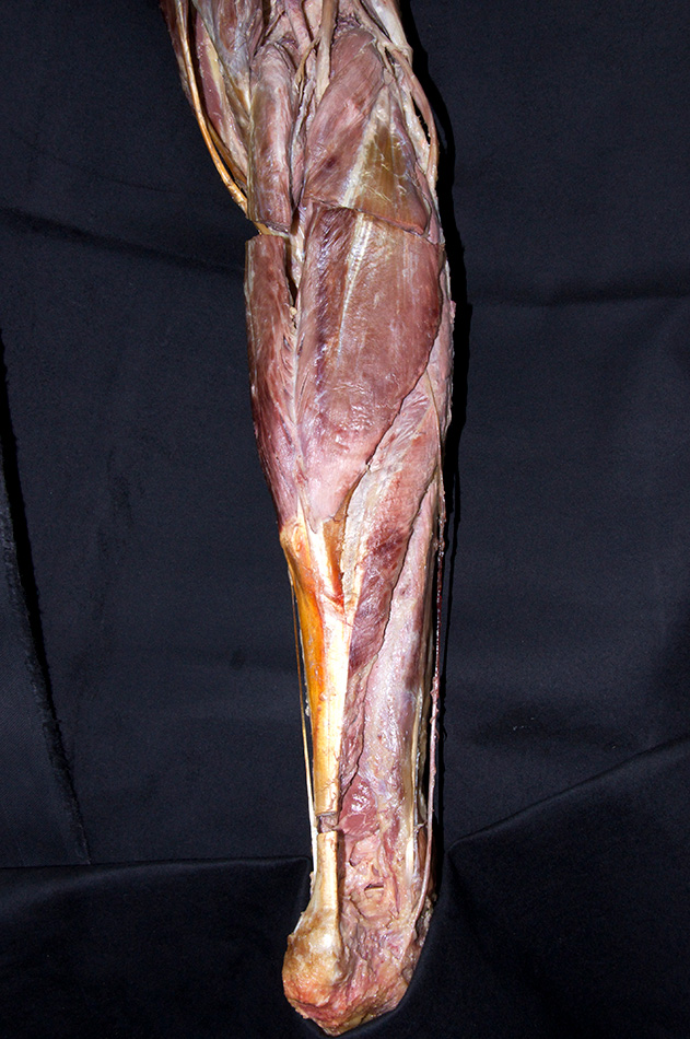 Calcaneal Tendon