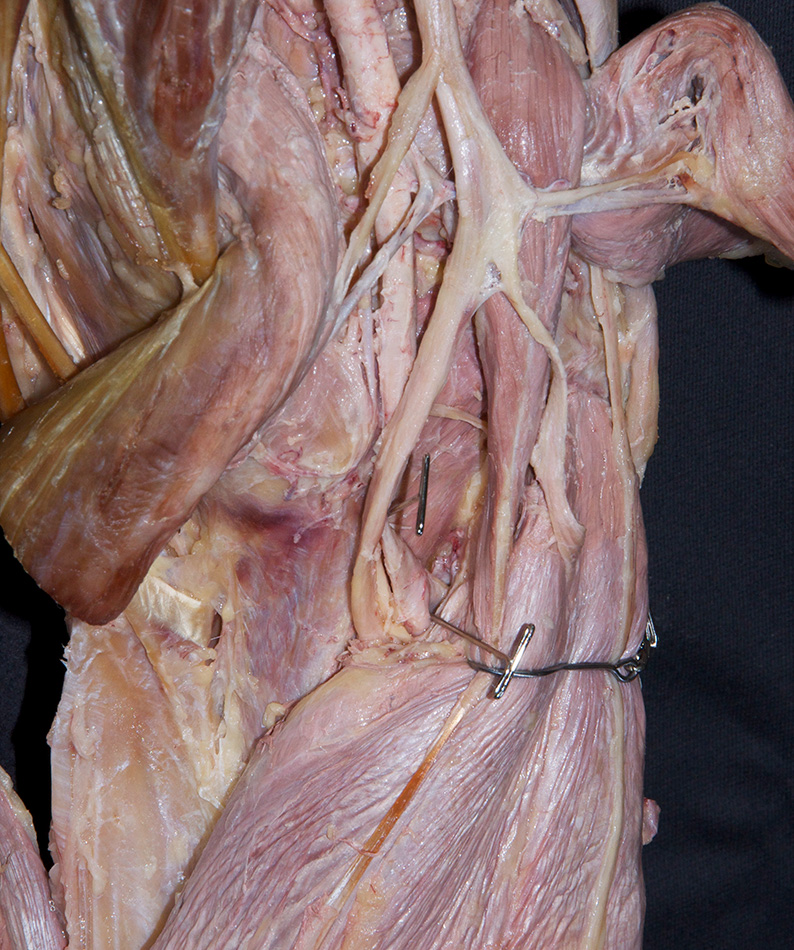 Anterior Tibial Artery (origin)