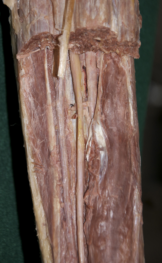 Peroneal Artery (unusually large)