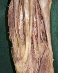 Distal Posterior Thigh