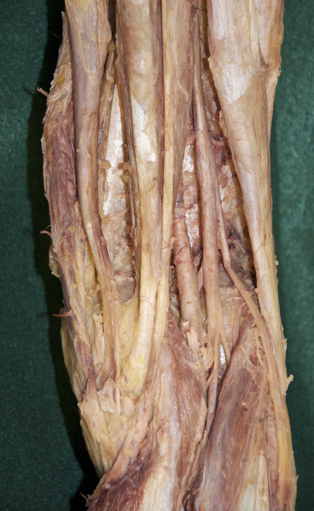 Posterior Thigh - 1