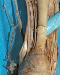 Distal Posterior Leg