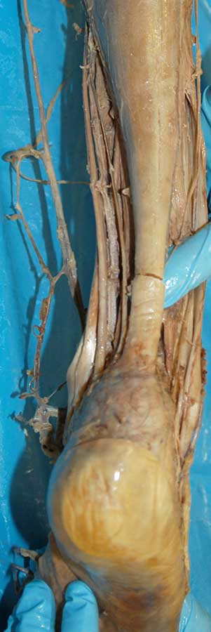 Posterior Leg - 1