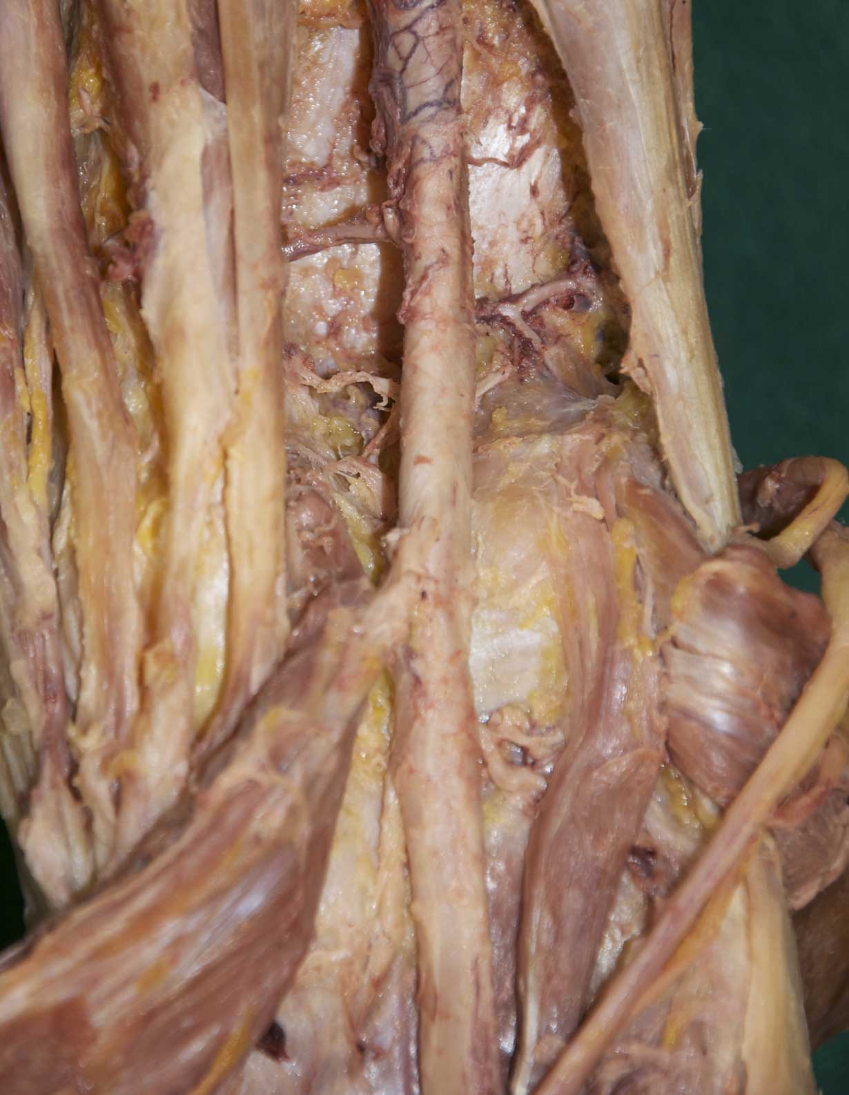 Popliteal Fossa - 2