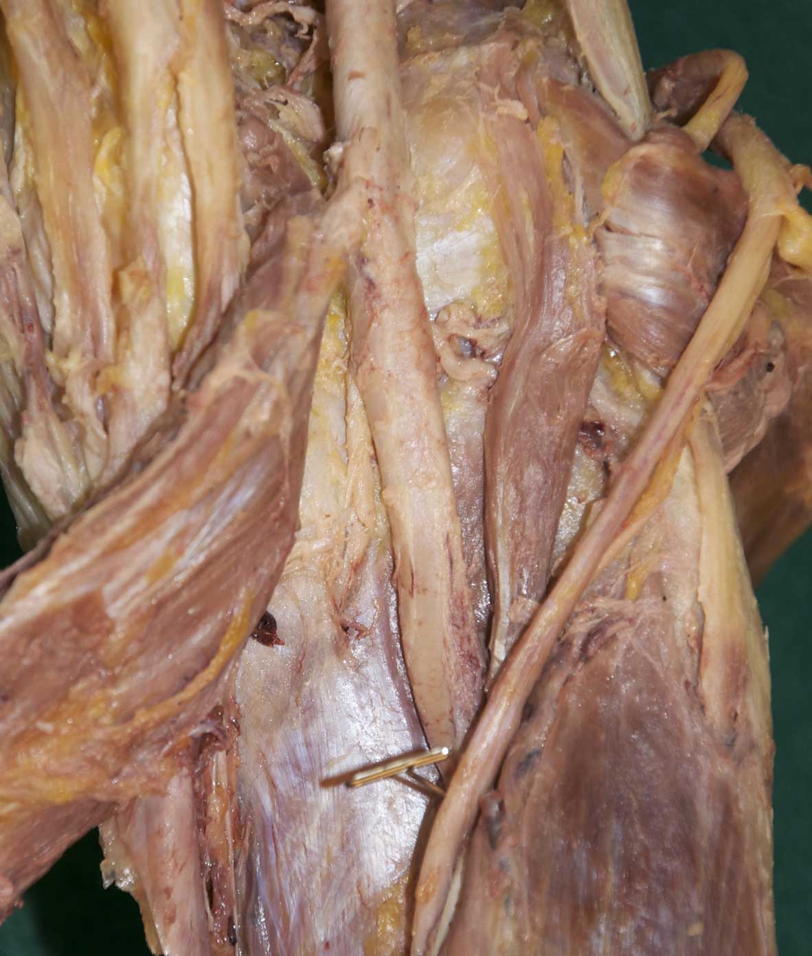 Popliteal Fossa - 3