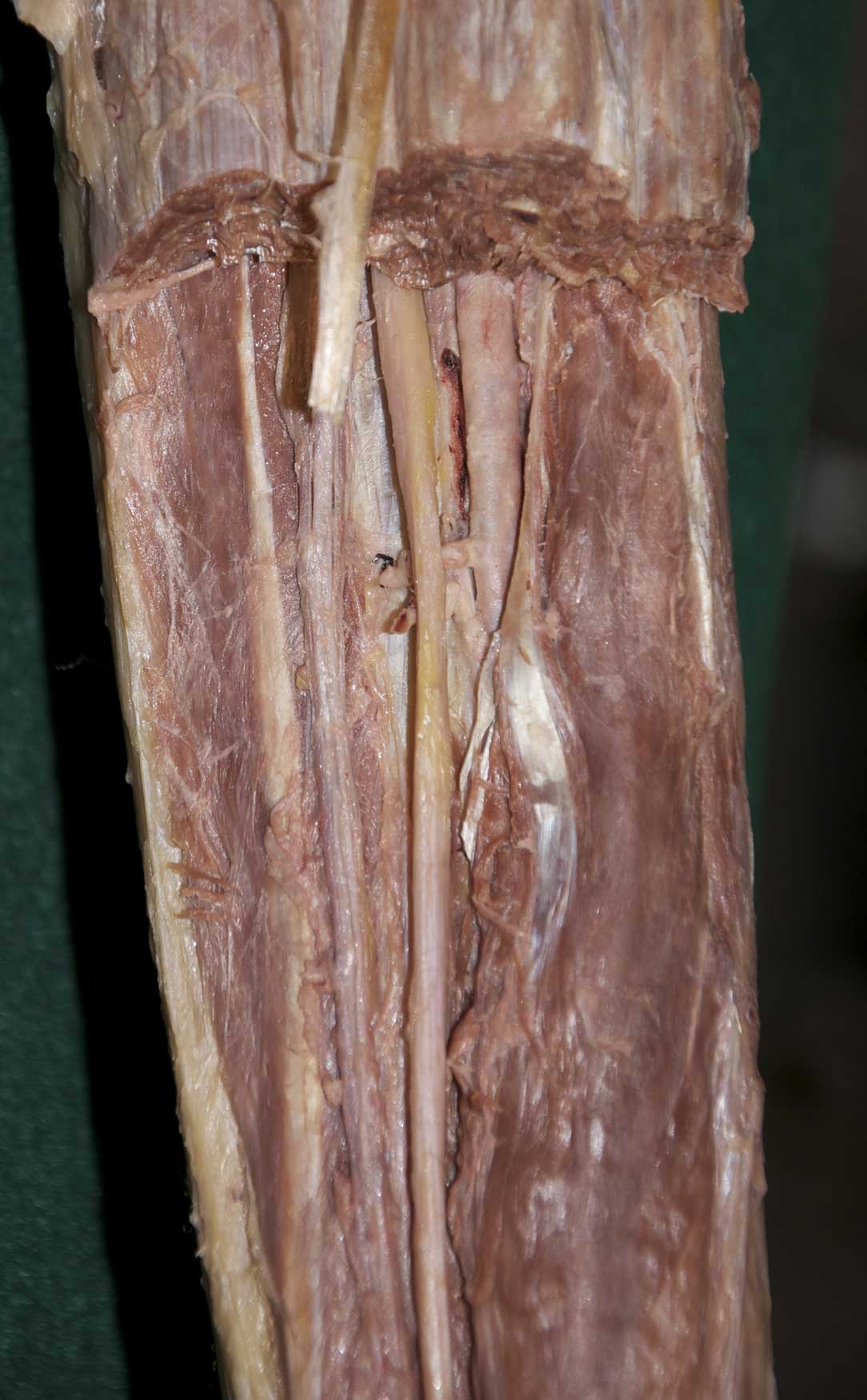 Posterior Leg - 2