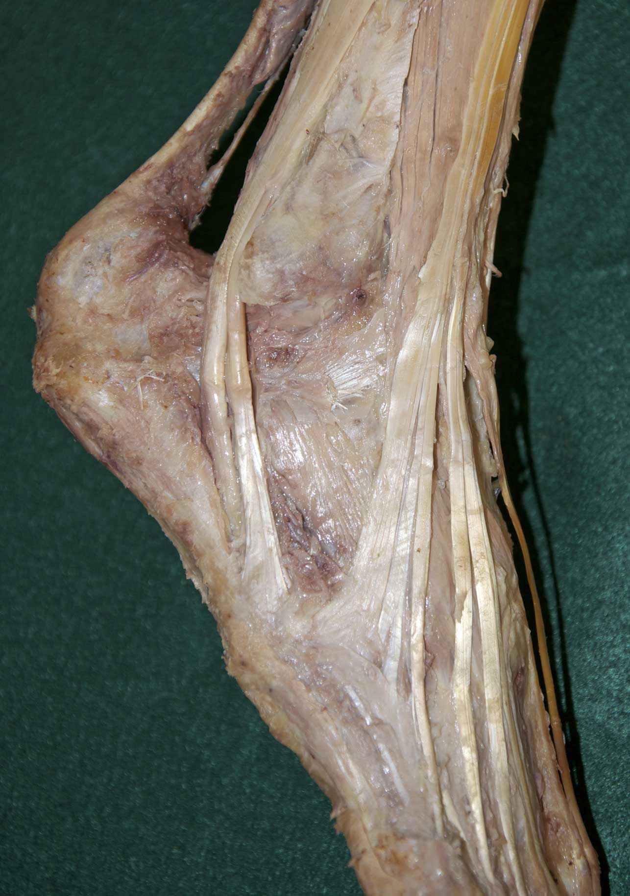 Dorsal Foot - 3