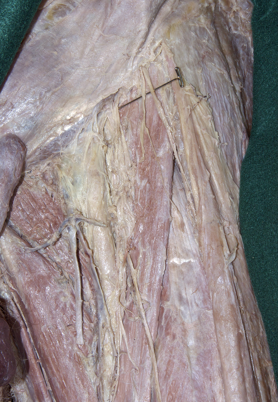 Anterior Thigh - 4