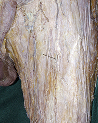 Deep Anterior Thigh