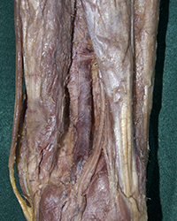 Distal Deep Popliteal Fossa