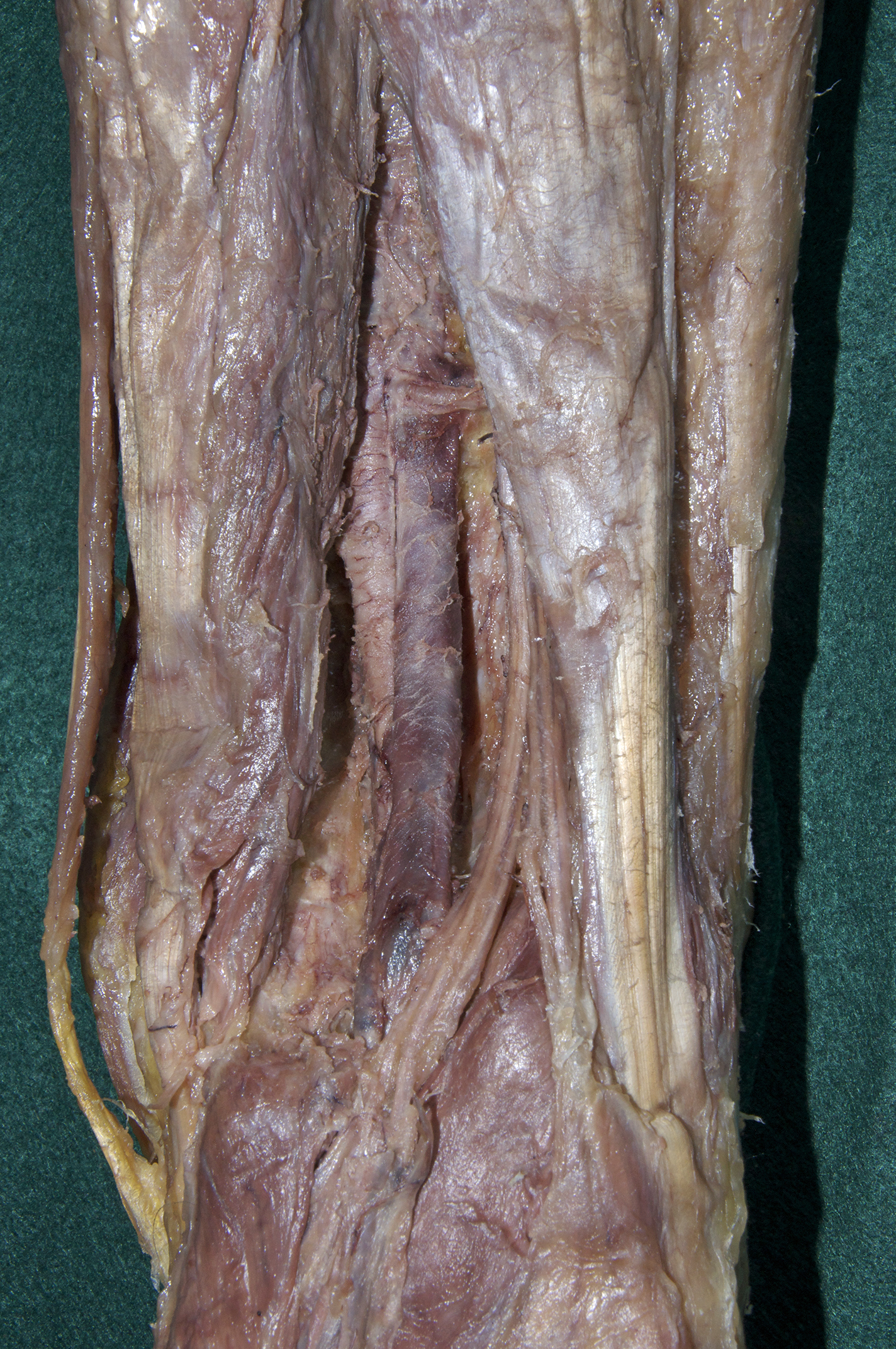 Popliteal Fossa - 4