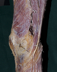 Knee Joint - Superior View