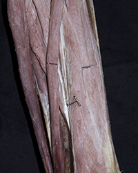 Erector Spinae Muscles