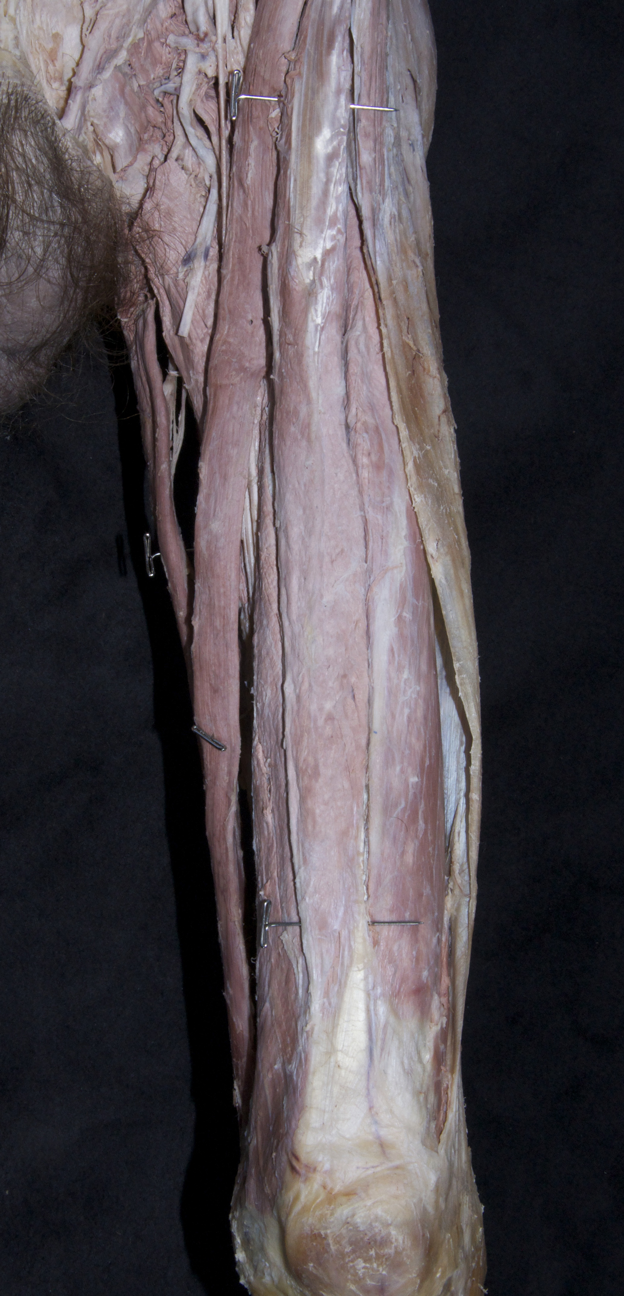 Anterior Thigh - 6