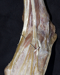 Erector Spinae Muscles