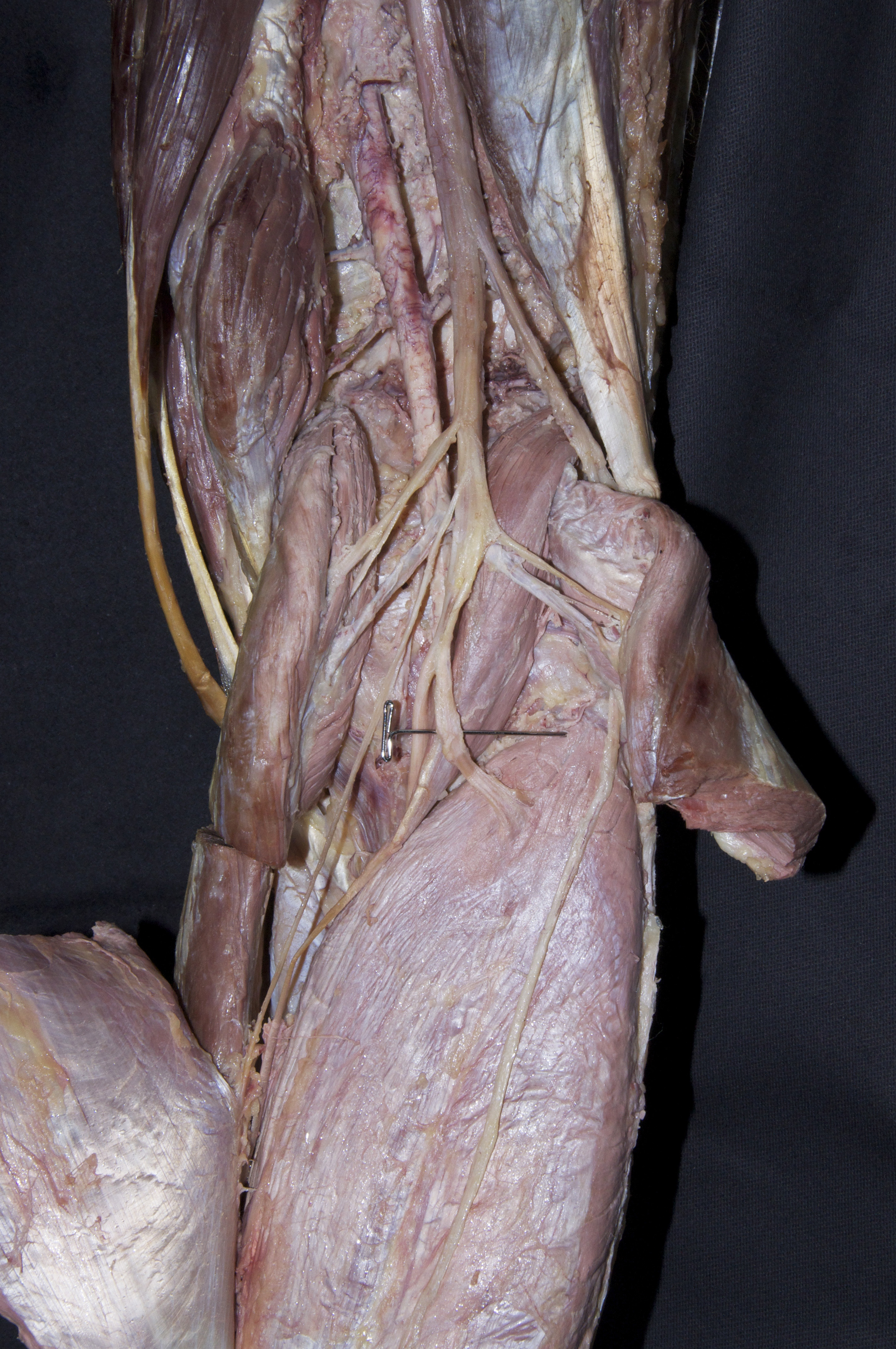 Popliteal Fossa - 5