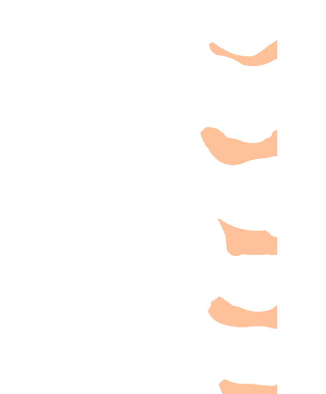 Intervertebral Discs (Artificial)