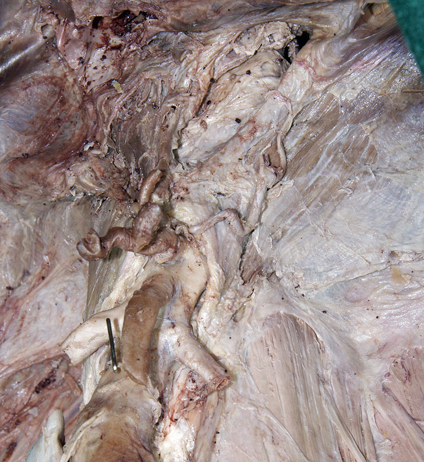 Left Inferior Phrenic Artery