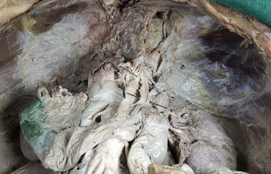 Suspensory Ligament of Duodenum
