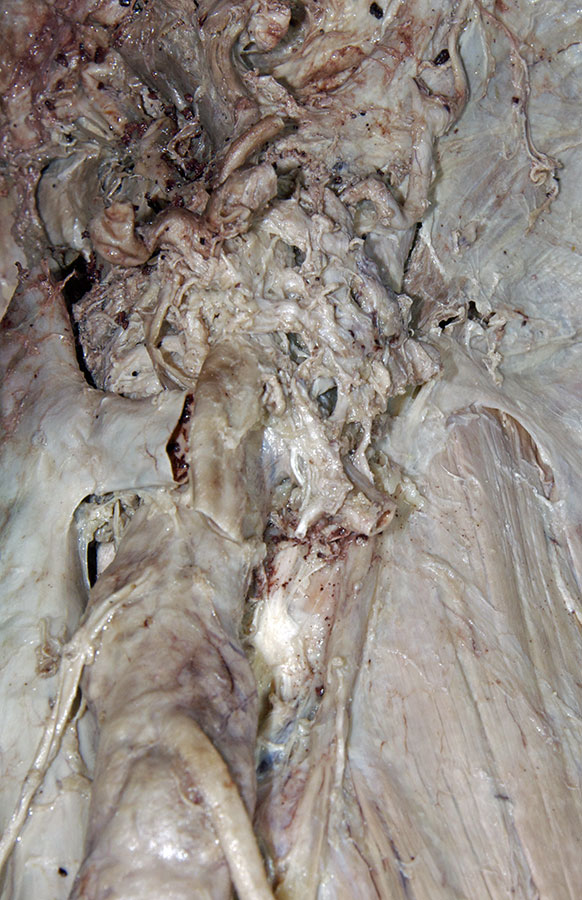 Left Celiac Ganglion