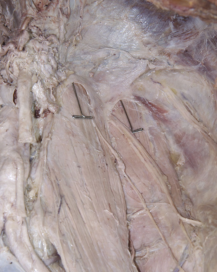 Left Arcuate Ligaments of the Diaphragm
