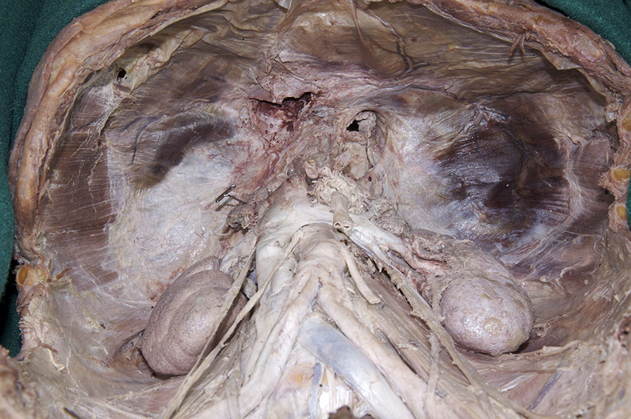 Central Tendon of Diaphragm
