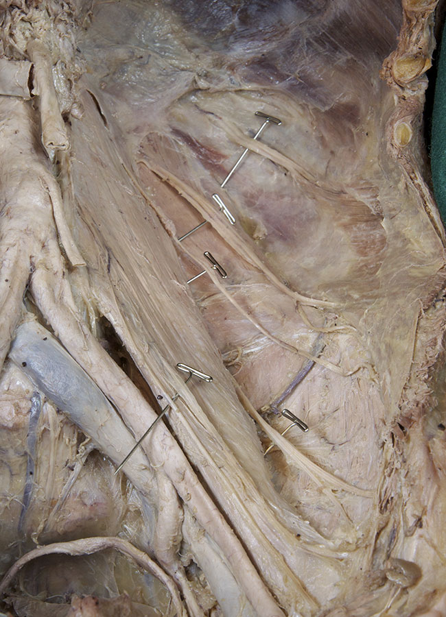 Posterior Abdominal Wall Nerves