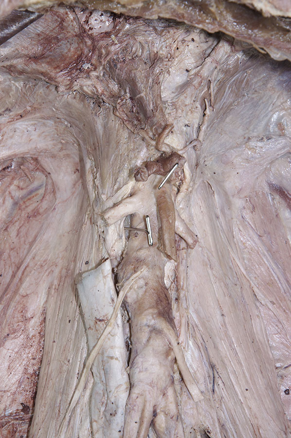 Crura of Diaphragm