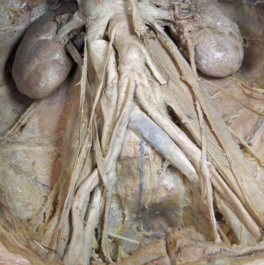 Common Iliac Vessels