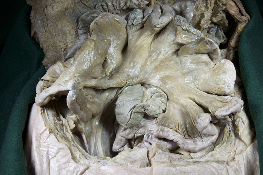Mesentery Proper