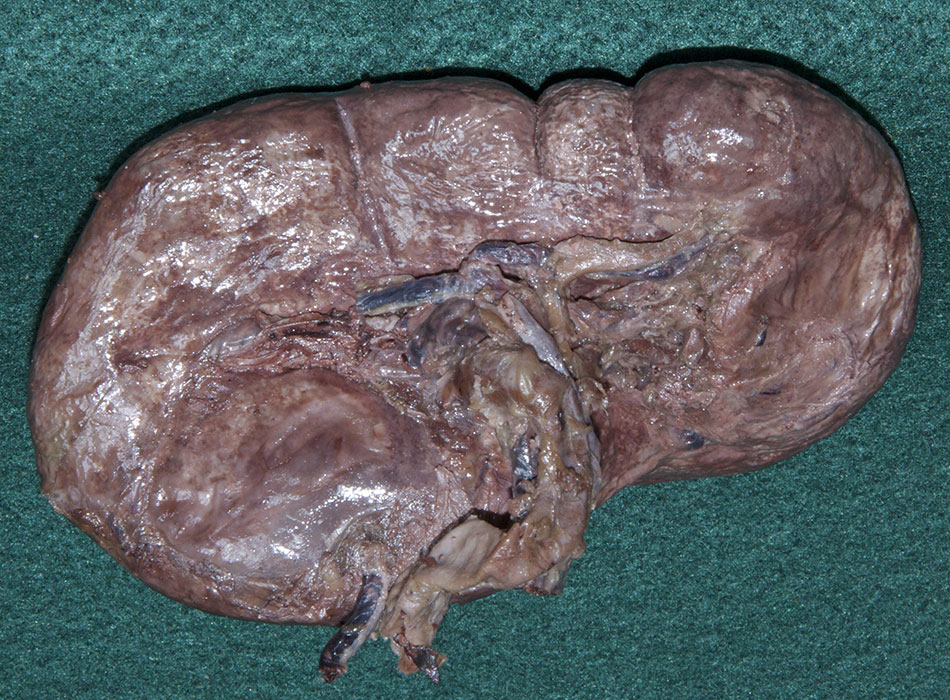 Spleen (visceral surface)