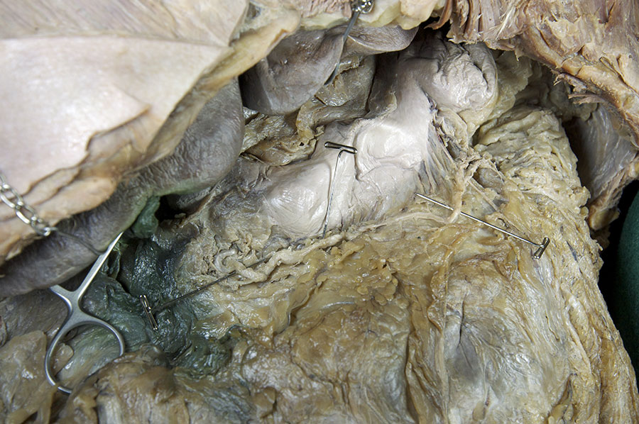 Gastroepiploic Arteries in Greater Omentum