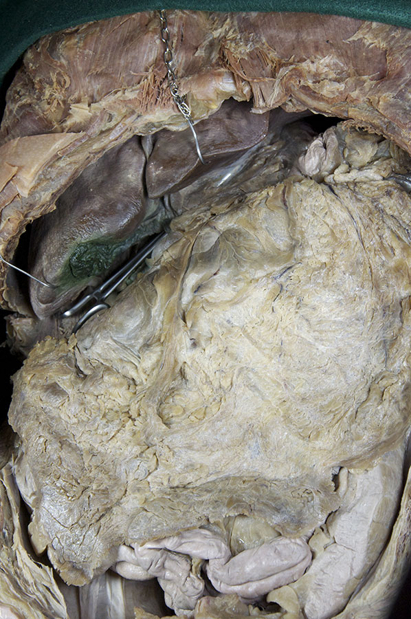 Greater Omentum
