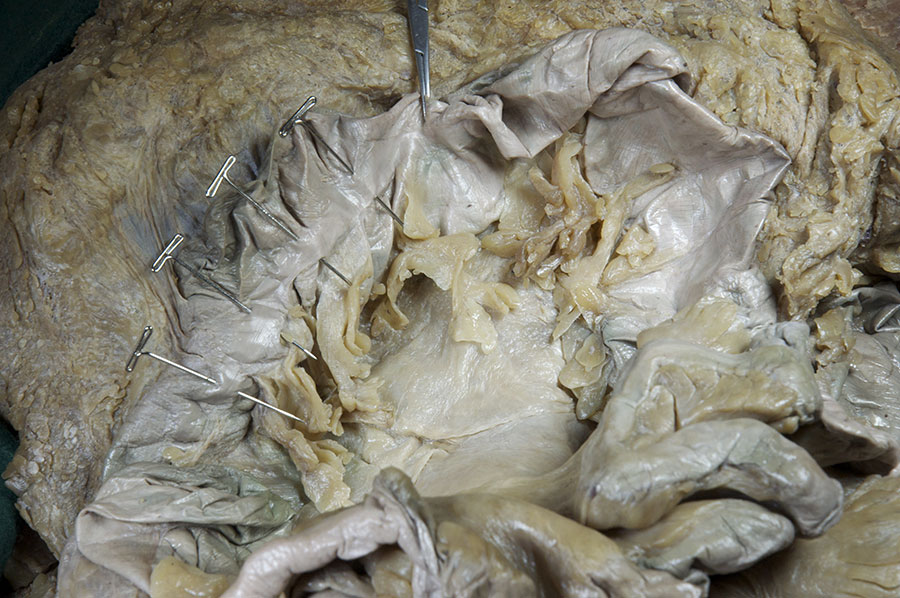 Teniae Coli