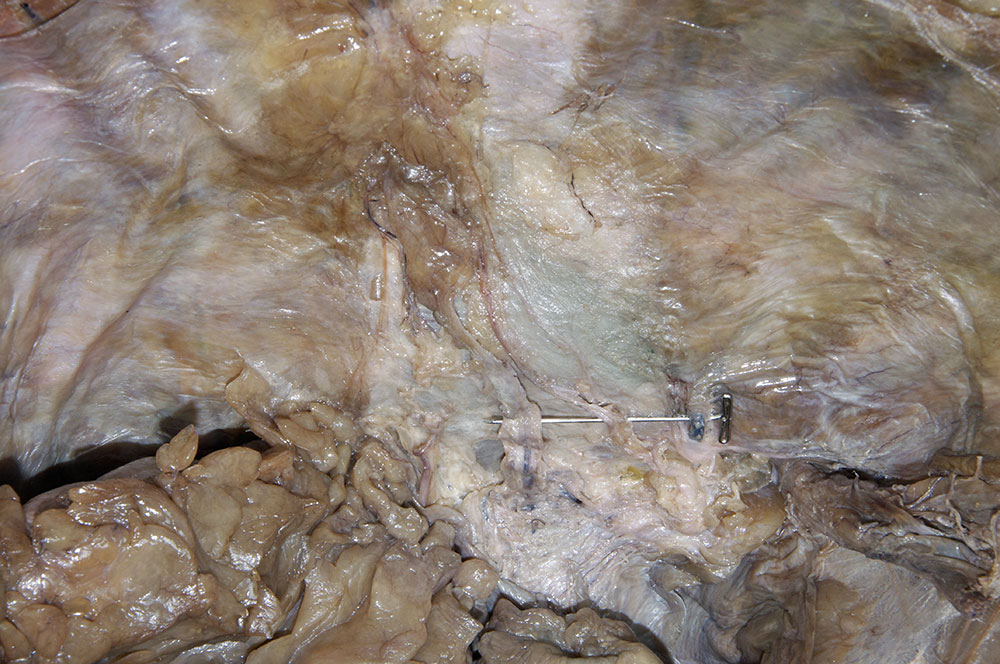 Anterior Abdominal Wall (peritoneal view)