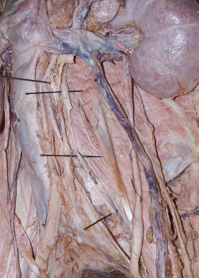 Left Lumbar Sympathetic Ganglia