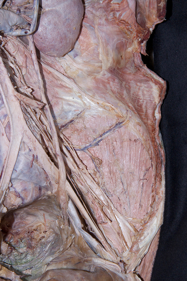 Iliacus Muscle