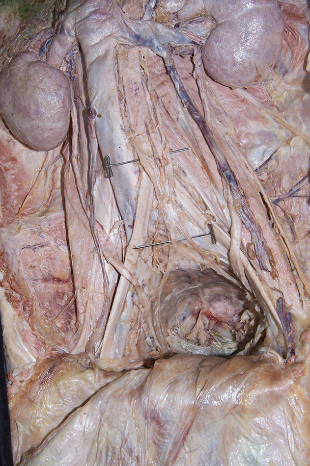 Hypogastric Plexus