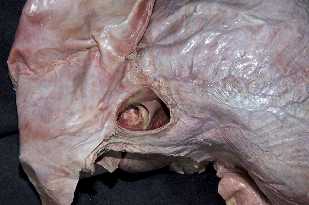 Hepatic Veins