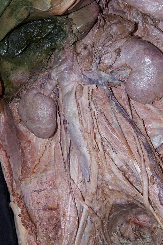 Right Kidney
