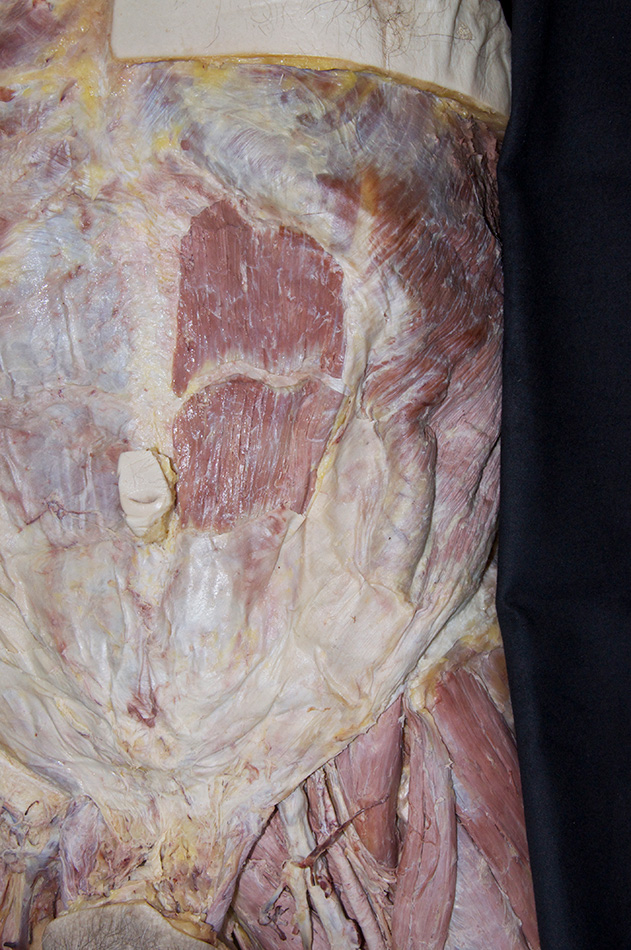 Rectus Abdominis Muscle