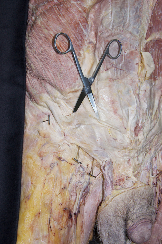 Step 7A Incision