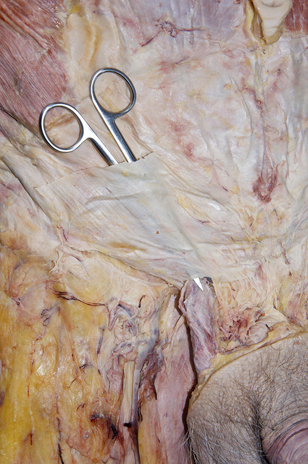 Step 7B Incision