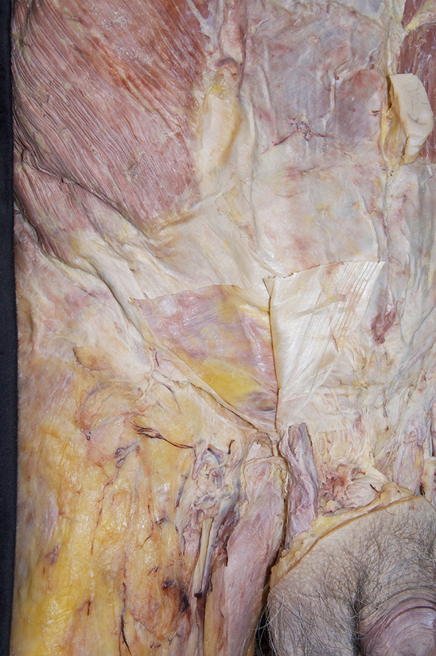 Step 7C Incision