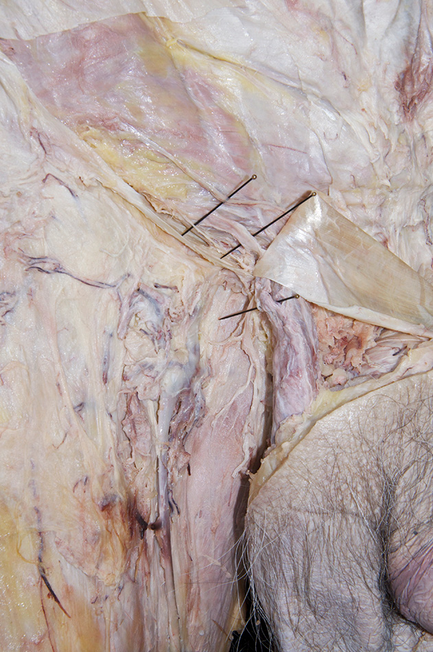 Iliohypogastric Nerve