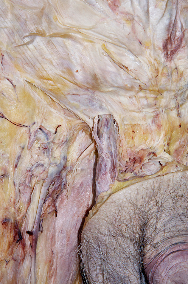 Superficial Inguinal Ring