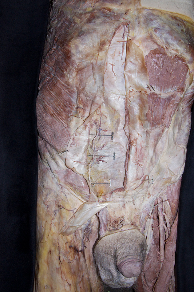 Posterior Rectus Sheath