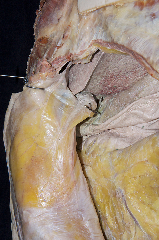 Falciform Ligament